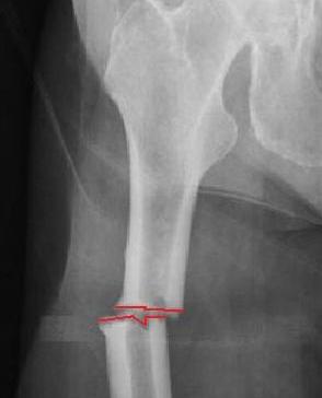 femoral fracture